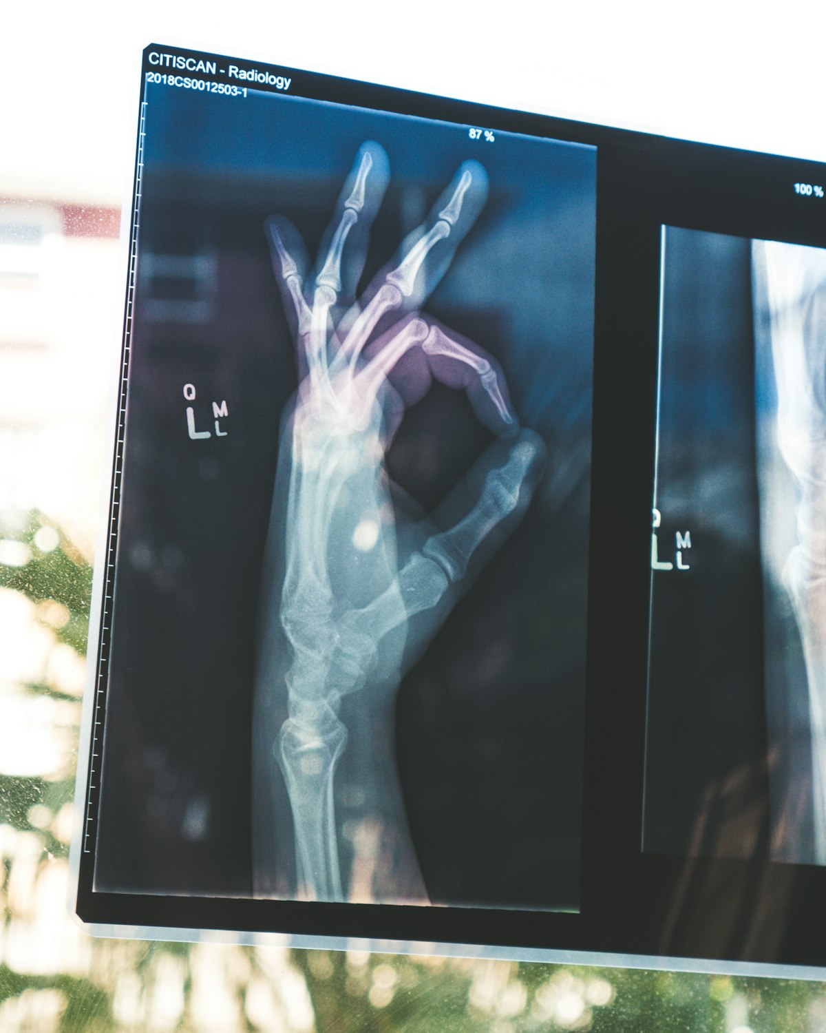 Hospital Indemnity vs Accident vs Critical Illness